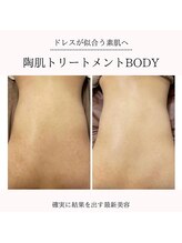 イルソーレ(IL Sole)/薄着になる前にハーブピーリング