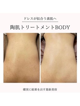 イルソーレ(IL Sole)/薄着になる前にハーブピーリング