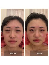 サロンドデュイ/1回施術/20代/乾燥肌/保湿ケア