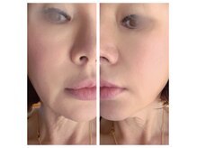 グラッソ(GRASSO)の雰囲気（《マイクロウェーブ》ほうれい線/フェイスラインスッキリ左右差）