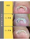 1カラー巻爪ケア ペディバランス