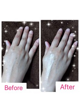 ルアナ(Luana)/BBL光ハンドトリートメント