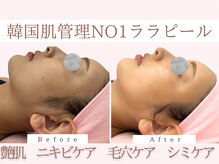 Cスキンケアクリニック 麻布店/ララピールBeforeAfter#ツヤ肌
