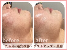 グロウ バイ フェイシャルデザイン アンド アイ(GROW)/たるみ改善/リフトアップ
