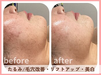 グロウ バイ フェイシャルデザイン アンド アイ(GROW)/たるみ改善/リフトアップ