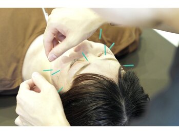 レスト(Rest)/美容鍼