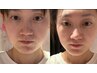 【顔面矯正】鼻の高さ/ほうれい線フェイスライン/小顔に効く 5800円