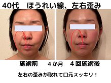 エンジェルエッグ/◆左右差の歪みが改善され小顔に