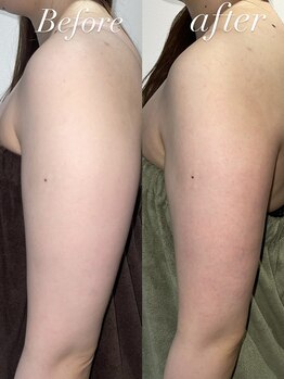 レシェルサロン(Lechelle Salon)/二の腕 レモンボトル1回目