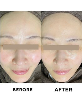 ゼロ 水戸店(ZERO)/シミ・シワ肌質改善スペシャル