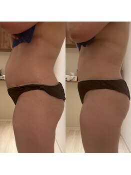 リハーツ(RE;heartz)/★－４℃脂肪冷却導入★