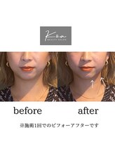 コア 中目黒店(Koa)/お客様ビフォーアフター！！
