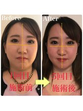 美容整体専門院 新美選/３Ｄ小顔矯正　変化写真