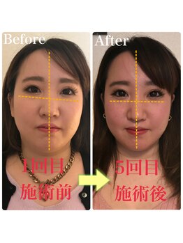 美容整体専門院 新美選/3D小顔矯正 変化写真