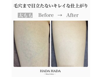 ハダハダ(HADA HADA Medical Esthetic)/太ももBefore→After★