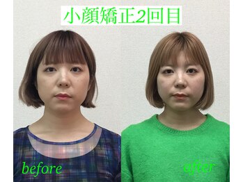 オズ六本木/小顔矯正モニター様2回目施術