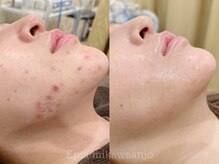 エピア 三河安城店(Epia)の雰囲気（今まで何をしてもキレイにならなかったニキビにも◎）