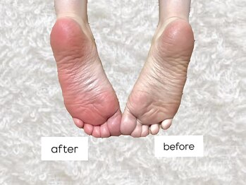わたしのネイルとよもぎ蒸しの写真/ガツンと刺激★《台湾式足つぼ¥2,980》 痛いのにクセになる！反射区で頭.目.鼻.耳.内臓.下半身へ血流促進◎