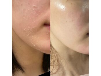 ギンザロッソ(GINZA ROSSO)の写真/台湾のスピキュールピーリングでハリある肌へ♪たるみ・リフトアップを丁寧にケア!