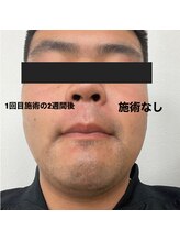 アールブイ(RV)/髭脱毛モニター