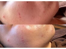 ルアーナ(Luana)/　ハーブピーリングで肌悩み改善