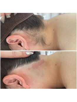 ミース 北九州店/うなじ○ビフォーアフター