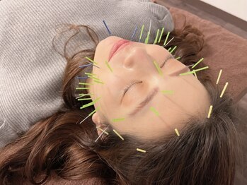 マイアート(My Art)の写真/《美容鍼＋ヘッドマッサージ》表情筋の筋緊張の緩和、頭皮のケアでお顔全体引き上げ小顔効果も抜群◎