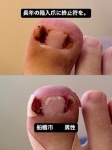 巻き爪じゅん 船橋店/陥入爪の痛みに向き合う