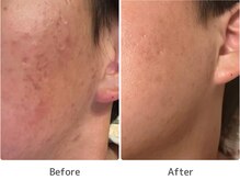 トータルビューティー ココ(Total Beauty CoCo)の雰囲気（10代｜ニキビ・肌表面の跡のケア改善症例）