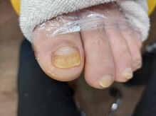 爪切り屋 足楽/変色・肥厚爪★【after】