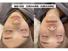 ナチュレアンドメディカ(Nature&Medica)/【たるみ改善】ソフウェーブ