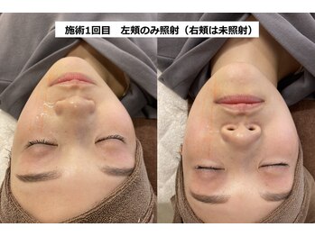 ナチュレアンドメディカ(Nature&Medica)/【たるみ改善】ソフウェーブ