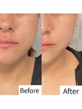 ヒカリエステ 六本木(HIKARI ESTHE)/切らない小顔リフト