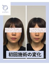 セレス(celes)/施術の変化