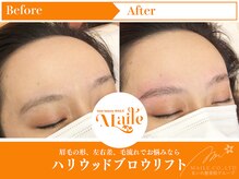 まいれ鍼灸院整骨院 整体院 草津院/ハリウッドブロウリフト/美眉