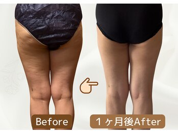 ヨサパークエモナ 船橋南口店(YOSAPARK E-mona)/気になるお尻のセルライトに！