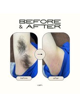 カルム(calm.)/メンズ脇脱毛