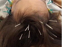 ほぐし堂/【頭髪鍼】脱毛など頭髪の悩みに