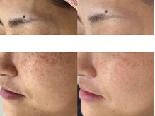 エヴェリーナ(Eveliiina)/シミケア18回目の経過写真