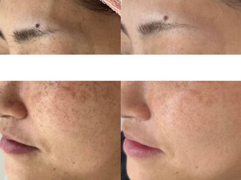 エヴェリーナ(Eveliiina)/シミケア18回目の経過写真