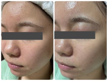 アズ(AZU)/赤みケアもお任せください♪