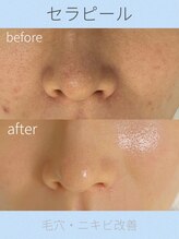 カピリナスパ(Ka.Pilina Spa) セラ ピール