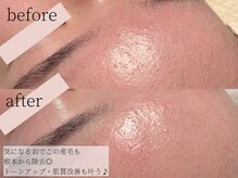 コモレビ(komorebi)/おでこ産毛除去艶肌へ♪