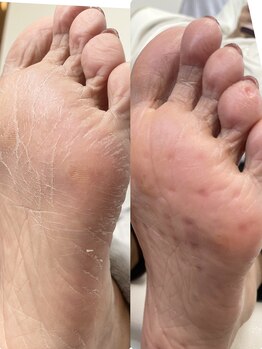 エクラプラス(Eclat.plus)/角質ケア