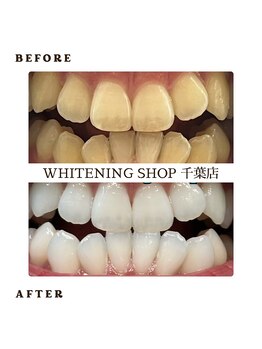 ホワイトニングショップ 千葉店/歯科提携 ホワイトニング専門店