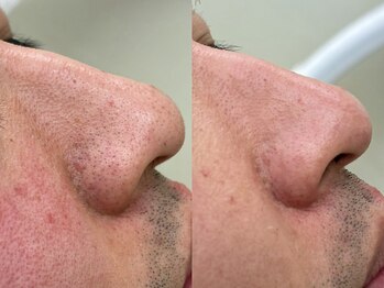 メンズフィオブロウ 大阪梅田店(men's fiio brow)の写真/肌に優しいワックスで痛みが少なく小鼻黒ずみ毛穴を整え好印象な清潔感を演出♪