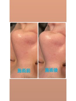 スムース(Smoooth)/毛穴美肌専門エステ