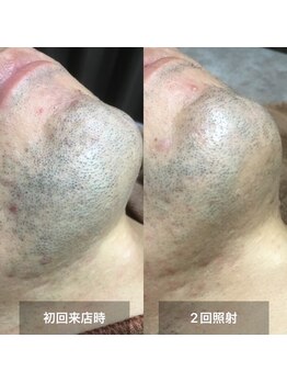 リムル(REMURU)/ひげ脱毛2回照射