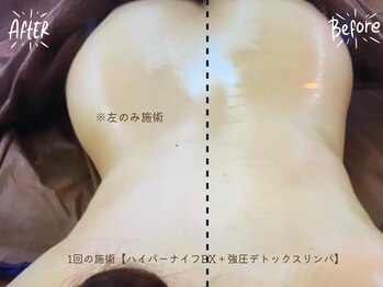 バーリブール 恵比寿店(BERLIBUR)/ハイパーナイフEX＆インド痩身