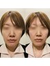 【高評価続々！速攻小顔！首肩こり解消も◎】シンメトリー小顔矯正45分